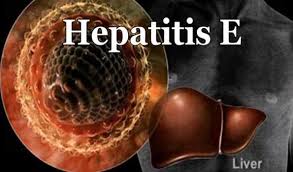 What are the symptoms of Hepatitis E?